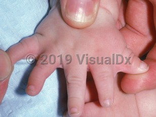 Clinical image of Oral-facial-digital syndrome - imageId=2376257. Click to open in gallery.  caption: 'Syndactyly and brachydactyly.'