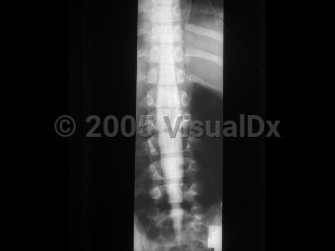 Imaging Studies image of Diastematomyelia - imageId=2381759. Click to open in gallery. 