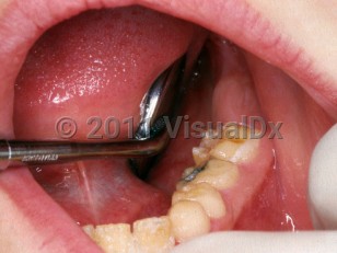 Clinical image of Amelogenesis imperfecta - imageId=2384456. Click to open in gallery.  caption: 'Pitting of the incisors and of the posterior molar.'