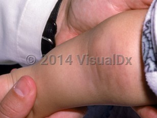 Clinical image of Tufted angioma - imageId=2384753. Click to open in gallery.  caption: 'A faint pink plaque with an uneven surface on the posterior thigh.'