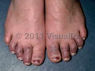 Clinical image of Raynaud phenomenon - imageId=239203. Click to open in gallery.  caption: 'Violaceous crusted plaques and papules on the toes.'