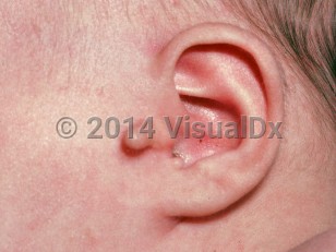 Clinical image of Accessory tragus - imageId=2398051. Click to open in gallery.  caption: 'Two preauricular papules anterior and inferior to the tragus.'