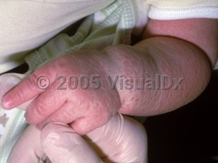 Clinical image of Severe combined immunodeficiency