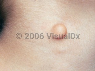 Clinical image of Cutaneous cartilaginous rest - imageId=2408736. Click to open in gallery.  caption: 'A close-up of a smooth yellowish nodule.'