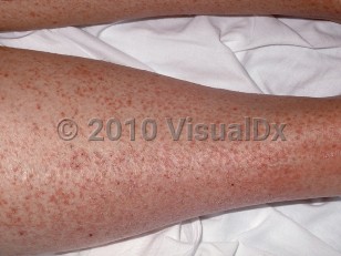 Clinical image of Hypereosinophilic syndrome - imageId=241116. Click to open in gallery.  caption: 'Widespread scaly erythematous papules (eczema) on the leg.'