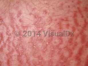 Clinical image of Polymorphic eruption of pregnancy - imageId=24163. Click to open in gallery.  caption: 'A close-up of urticarial plaques arising within striae.'