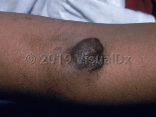 Clinical image of Plexiform neurofibroma - imageId=2423515. Click to open in gallery.  caption: 'A smooth dark brown nodule on the arm.'