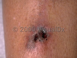 Clinical image of Mucormycosis - imageId=242772. Click to open in gallery.  caption: 'A close-up of a gray and violaceous plaque with central hemorrhagic erosions and crusts.'