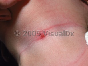 Clinical image of Thyroglossal duct cyst - imageId=2428380. Click to open in gallery.  caption: 'An eroded shiny papule on the anterior neck.'