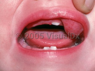 Clinical image of Oral lymphangioma - imageId=2446917. Click to open in gallery.  caption: 'A mucosal nodule arising from the upper lip.'