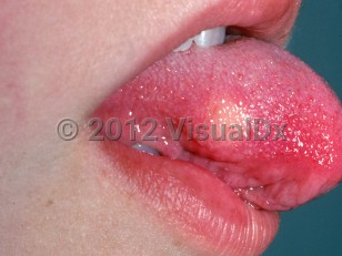 Clinical image of Granular cell tumor - imageId=2449538. Click to open in gallery.  caption: 'A yellowish nodule on the lateral tongue.'