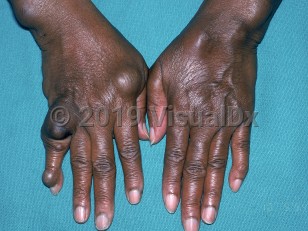 Clinical image of Maffucci syndrome - imageId=2475525. Click to open in gallery.  caption: 'Hyperpigmented, blueish and skin-colored papules and nodules on the wrists, hands, and fingers.'