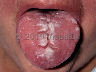 Clinical image of Fissured tongue - imageId=247783. Click to open in gallery.  caption: 'A deep central furrow with smaller, shallower furrows branching off it on the central tongue. Note also the white plaques (superimposed candidiasis). '