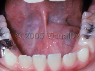 Clinical image of Ranula - imageId=2486748. Click to open in gallery.  caption: 'Shiny papules on both sides of the midline of the floor of the mouth.'
