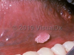Clinical image of Oral papilloma - imageId=2487516. Click to open in gallery.  caption: 'A pink and whitish verrucous papule on the ventral tongue.'