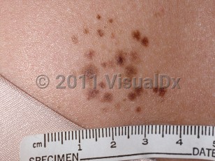 Clinical image of Agminated nevus - imageId=248880. Click to open in gallery.  caption: 'A close-up of a cluster of light and mid-brown macules and papules.'
