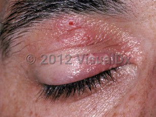 Clinical image of Herpes simplex virus blepharitis
