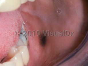 Clinical image of Oral melanoacanthoma