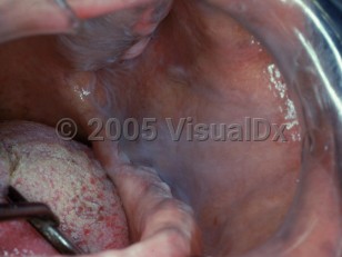 Clinical image of Leukoedema - imageId=2492217. Click to open in gallery.  caption: 'Whitish striations on the gingival-alveolar and buccal mucosa.'