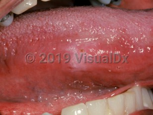 Clinical image of Oral frictional hyperkeratosis - imageId=2492737. Click to open in gallery.  caption: 'A subtle white papule on the lateral tongue.'