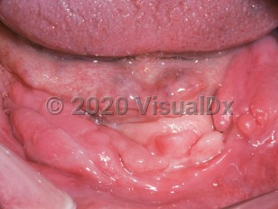 Clinical image of Denture-induced hyperplasia