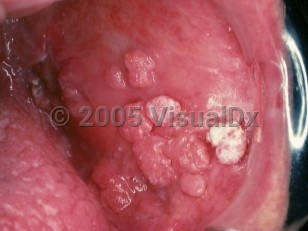 Clinical image of Verrucous carcinoma - imageId=2494752. Click to open in gallery.  caption: 'Numerous, substantive, pink-white, flat-topped verrucous papules on the buccal mucosa (oral florid papillomatosis).'