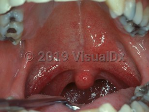 Clinical image of Benign salivary gland tumor - imageId=2497612. Click to open in gallery.  caption: 'A pleomorphic adenoma presenting as a smooth nodule on the palate.'