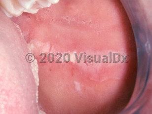 Clinical image of Contact stomatitis - imageId=2498881. Click to open in gallery.  caption: 'An elongated white plaque on the buccal mucosa and a white keratotic plaque on the lateral tongue (cinnamon reaction).'