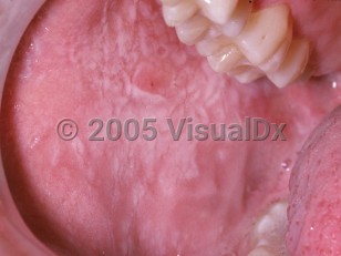 Clinical image of White sponge nevus of the oral mucosa