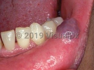 Clinical image of Oral varices - imageId=2500117. Click to open in gallery.  caption: 'A purple-blue papule on the lower mucosal lip.'