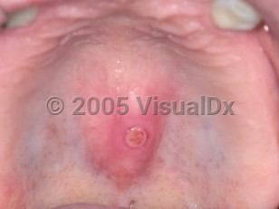 Clinical image of Traumatic oral ulcer - imageId=2500473. Click to open in gallery.  caption: 'A round crusted ulcer over a torus palatini.'
