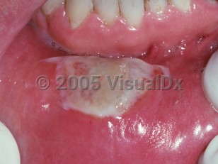 Clinical image of Traumatic eosinophilic granuloma - imageId=2501567. Click to open in gallery.  caption: 'A slough-covered plaque on the mucosal lip.'