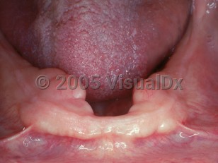 Clinical image of Torus mandibularis - imageId=2501810. Click to open in gallery.  caption: 'Smooth nodules at the lower gingival-alveolar margin.'
