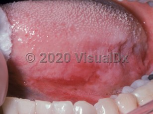 Clinical image of Oral erythroplakia