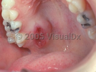 Clinical image of Malignant salivary gland tumor - imageId=2503185. Click to open in gallery.  caption: 'A mucoepidermoid carcinoma appearing as an eroded nodule on the palate.'