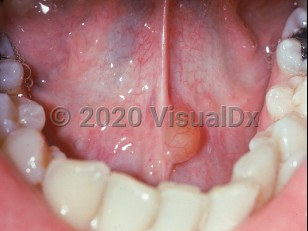 Clinical image of Lymphoepithelial cyst - imageId=2503988. Click to open in gallery.  caption: 'A translucent yellowish papule on the frenulum.'