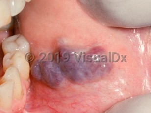 Clinical image of Oral hemangioma