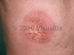 Clinical image of Radiation dermatitis - imageId=250723. Click to open in gallery.  caption: 'A close-up of a circular, thin, wrinkled, erythematous plaque with telangiectasias and scarring, following therapeutic radiation.'