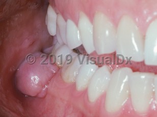 Clinical image of Peripheral ossifying fibroma - imageId=2508938. Click to open in gallery.  caption: 'A smooth pink nodule at the gingival margin.'
