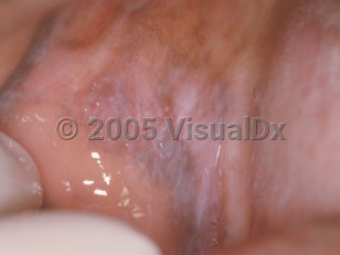 Clinical image of Oral lichen planus - imageId=2514944. Click to open in gallery.  caption: 'A macerated white plaque with a lacy appearance on the buccal mucosa.'