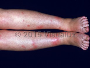 Clinical image of Ulcerative colitis - imageId=2527215. Click to open in gallery.  caption: 'Widespread erythematous nodules on the shins and feet of a patient.'