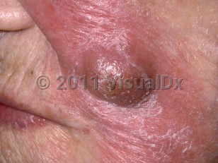 Clinical image of Actinomycosis - imageId=252777. Click to open in gallery.  caption: 'An erythematous plaque with overlying superficial scale and a central similar crusted nodule on the cheek.'