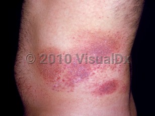 Clinical image of Poikiloderma vasculare atrophicans - imageId=2528576. Click to open in gallery.  caption: 'A broad poikilodermatous plaque with white atrophic  and violaceous scaly portions on the flank.'