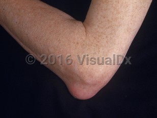 Clinical image of Bursitis - imageId=2529215. Click to open in gallery.  caption: 'A faint pink nodule over the elbow.'