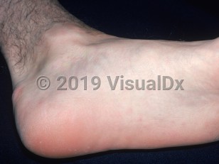 Clinical image of Streptobacillus moniliformis rat-bite fever - imageId=2529756. Click to open in gallery.  caption: 'Faint erythematous macules and thin papules on the foot.'