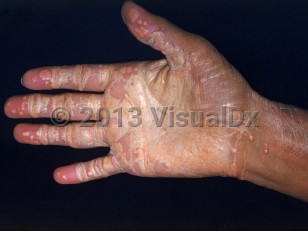 Clinical image of Werner syndrome - imageId=2529983. Click to open in gallery. 