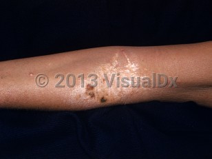 Clinical image of Biliary hypercholesterolemic xanthomatosis - imageId=2530304. Click to open in gallery.  caption: 'A scaly and crusted, yellow plaque with surrounding similar papules at the antecubital fossa. Note also the similar solitary papule on the forearm.'