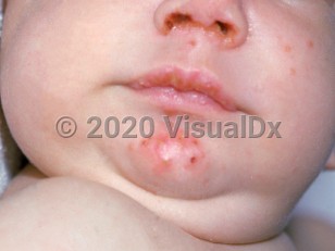 Clinical image of Congenital agammaglobulinemia