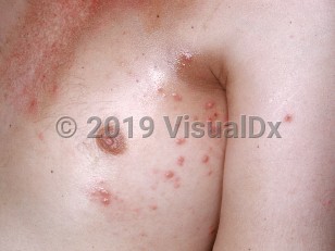 Clinical image of Hodgkin lymphoma - imageId=2531006. Click to open in gallery.  caption: 'Many smooth light pink and somewhat grayish papules on the chest and a similar crusted papule on the arm.'