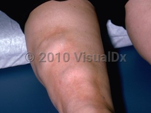 Clinical image of Eosinophilic fasciitis - imageId=253795. Click to open in gallery.  caption: 'Skin-colored nodules with a surrounding bound-down appearance of the thigh.'